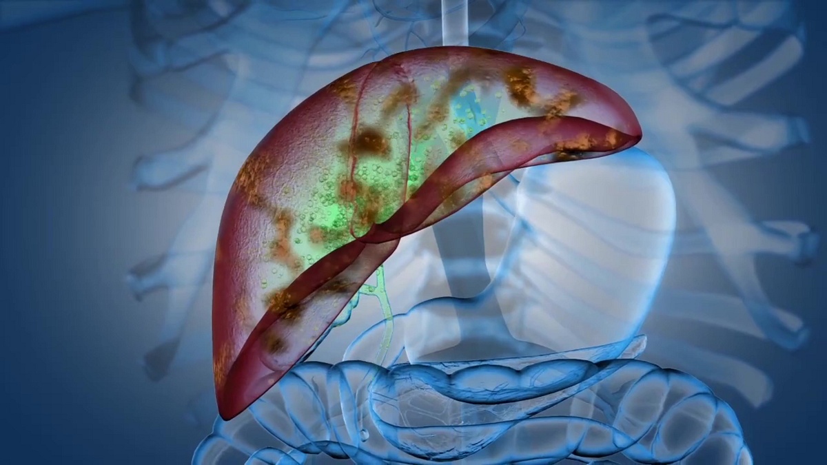 醫警告「4習慣不改」恐突然爆猛爆性肝炎！ 天天吞保健品也中招