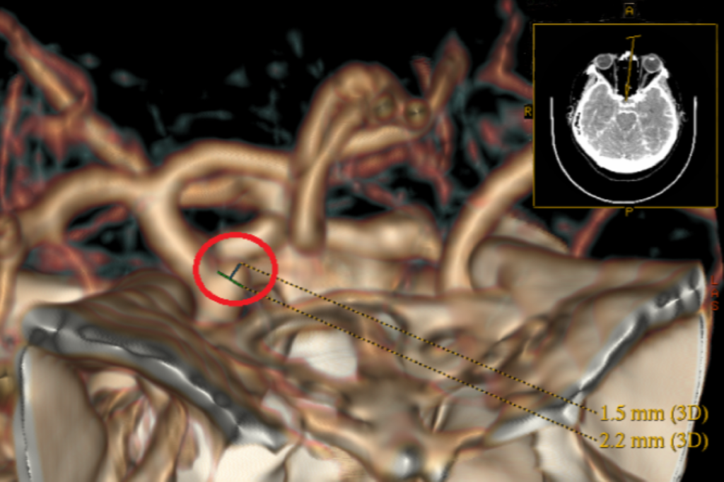 婦動脈瘤劇烈頭痛 開顱夾閉救命