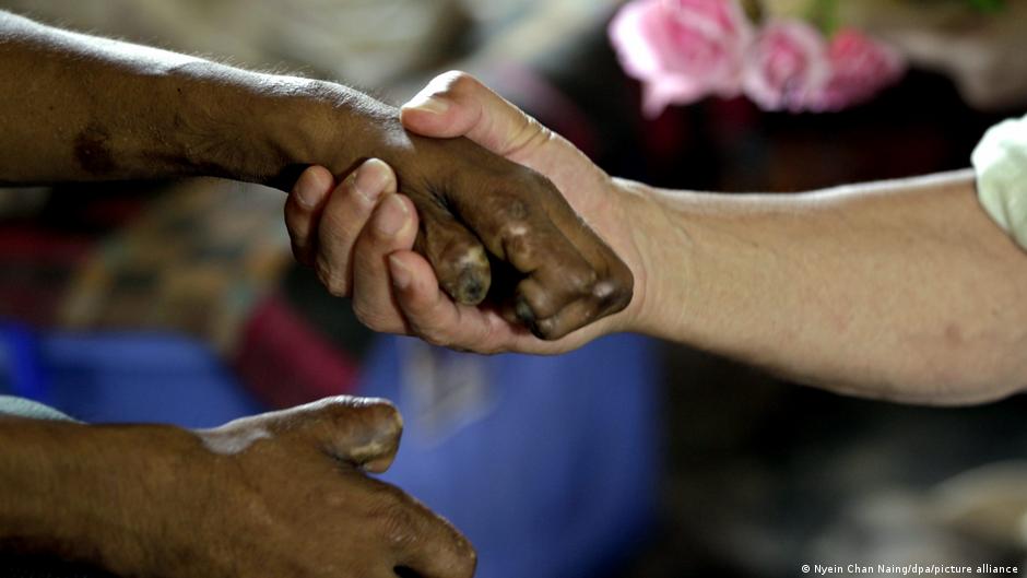 世界防治麻風病日：窮人的疾病缺乏關注