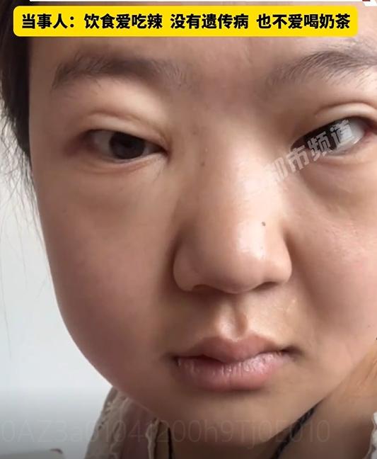 體重暴增30kg！陸女以為吃胖狂減肥　臉腫手麻竟是「尿毒症」