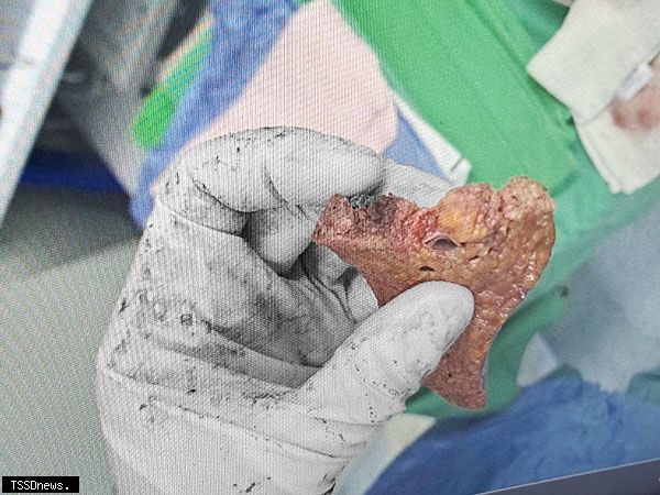 無甜不歡 肝臟逾六成全是脂肪肝